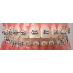 Brackets Agile MBT 022 1 Caso (20u) #